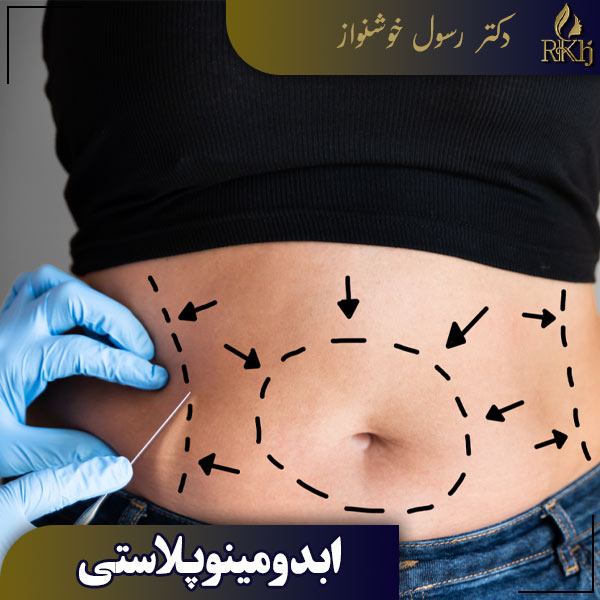 ابدومینوپلاستی