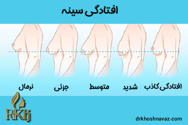 عکس افتادگی سینه - جراحی لیفت سینه -drkhoshnavaz.com