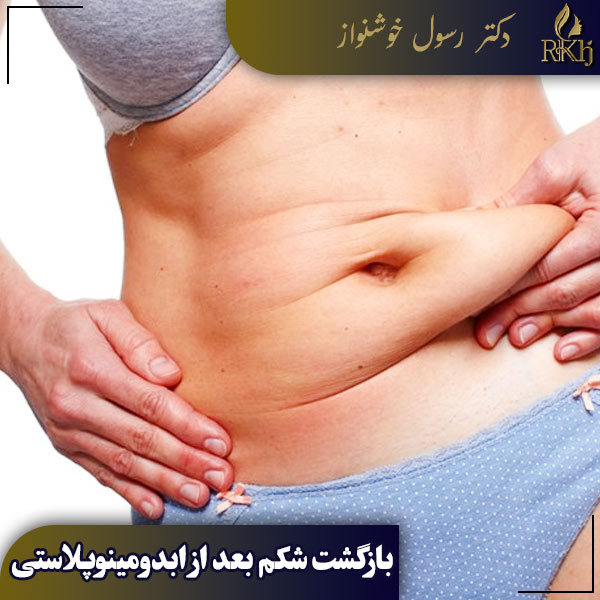 بازگشت شکم بعد از ابدومینوپلاستی