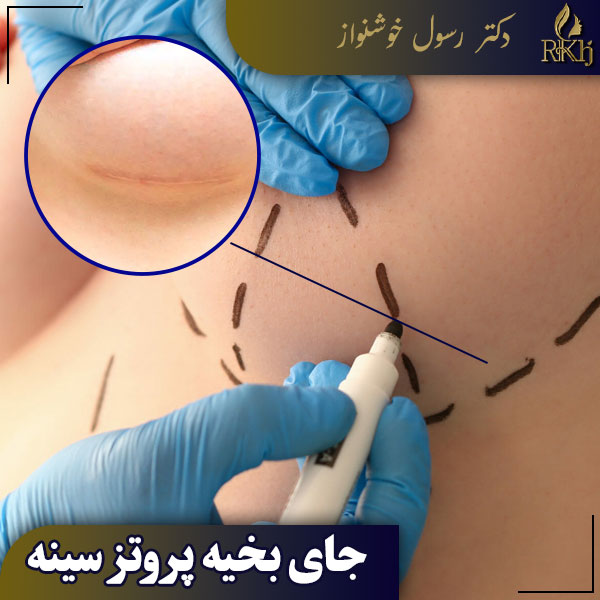 جای بخیه پروتز سینه