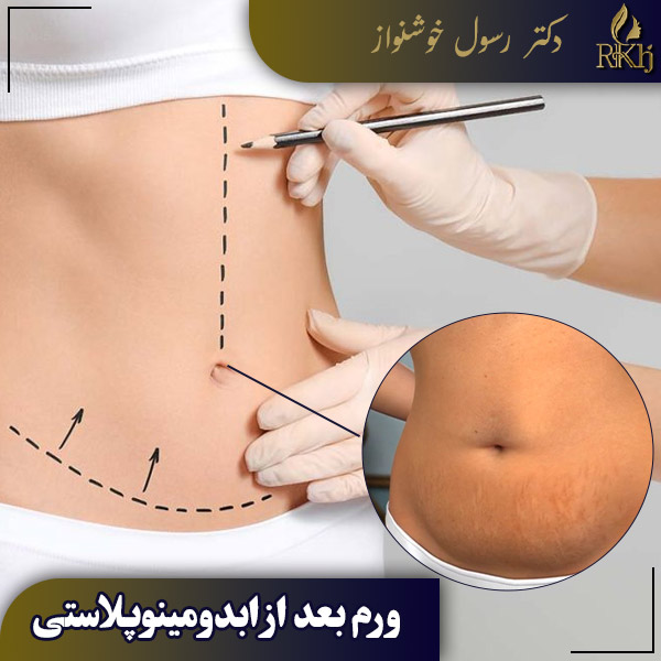 ورم بعد از ابدومینوپلاستی