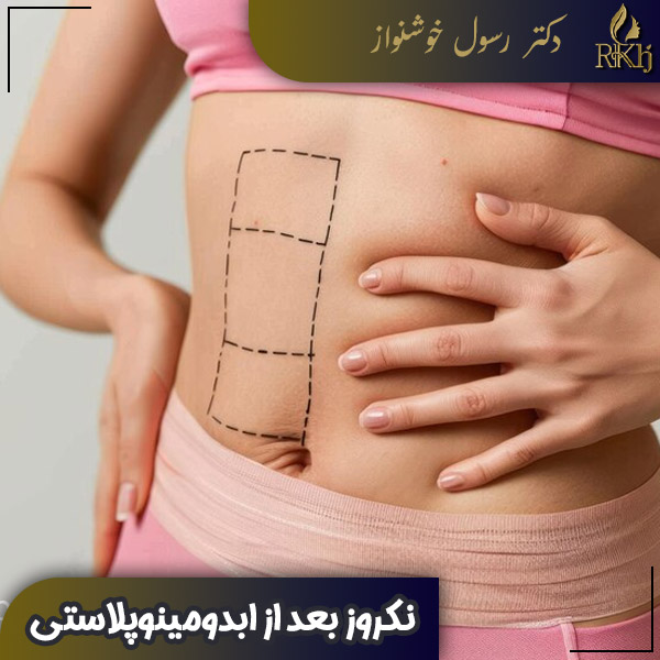 نکروز بعد از ابدومینوپلاستی - دکتر رسول خوشنواز