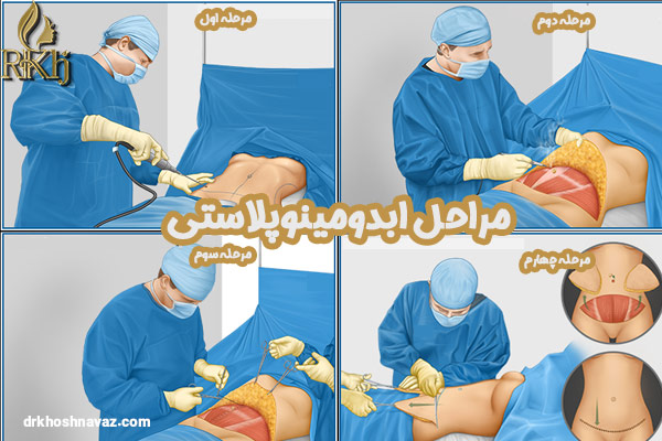 مراحل جراحی زیبایی شکم 