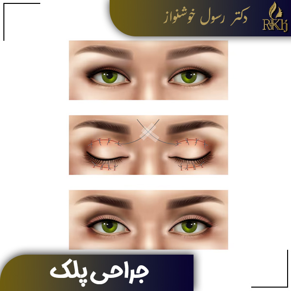 بلفاروپلاستی - دکتر رسول خوشنواز
