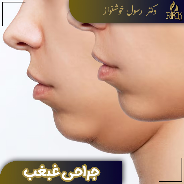 جراحی غبغب در کرج - دکتر رسول خوشنواز