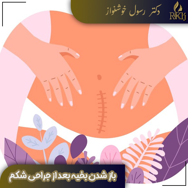 باز شدن بخیه بعد از جراحی شکم