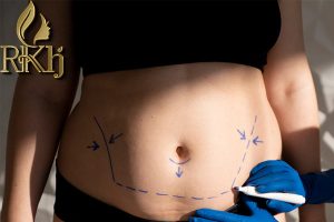 جراحی پیکرتراشی در کرج - دکتر خوشنواز -drkhoshnavaz.com