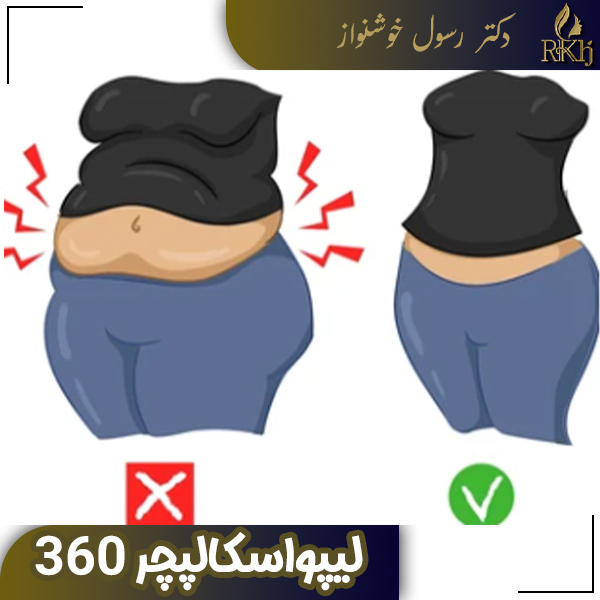 لیپواسکالپچر 360 - دکتر رسول خوشنواز