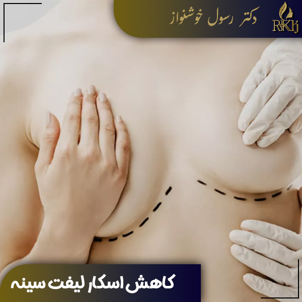 کاهش اسکار بعد لیفت سینه - دکتر رسول خوشنواز