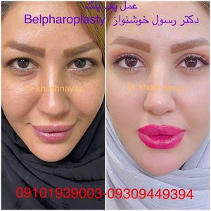 عکس جراحی زیبایی پلک - دکتر خوشنواز - drkhoshnavaz.com