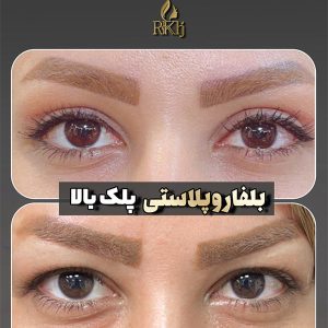 عکس عمل زیبایی پلک - دکتر خوشنواز - drkhoshnavaz.com