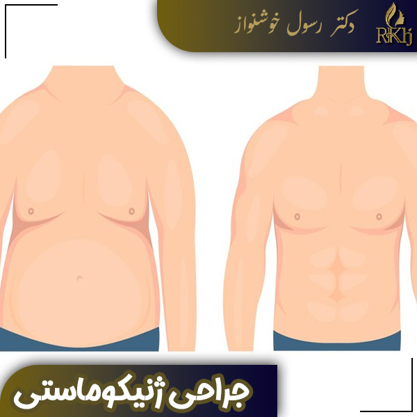 جراحی ژنیکوماستی - دکتر رسول خوشنواز