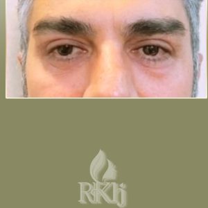 عکس بلفاروپلاستی مردان - دکتر خوشنواز - drkhoshnavaz.com
