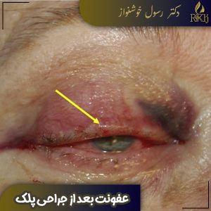 عفونت بعد از جراحی پلک - دکتر رسول خوشنواز