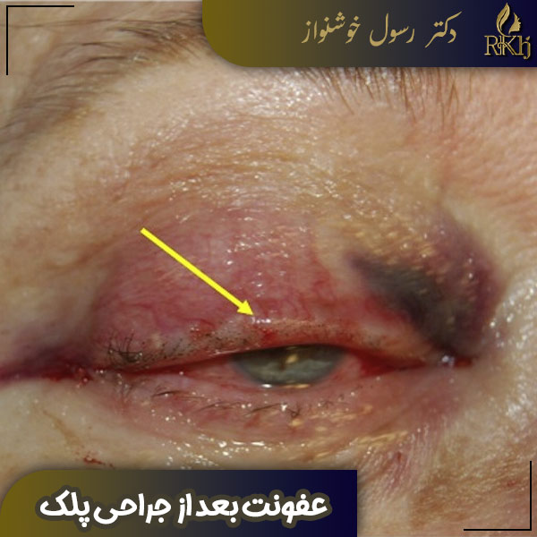 عفونت بعد از جراحی پلک - دکتر رسول خوشنواز