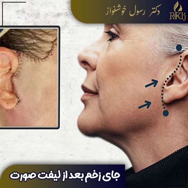 جای زخم بعد از لیفت صورت - دکتر خوشنواز - /drkhoshnavaz.com