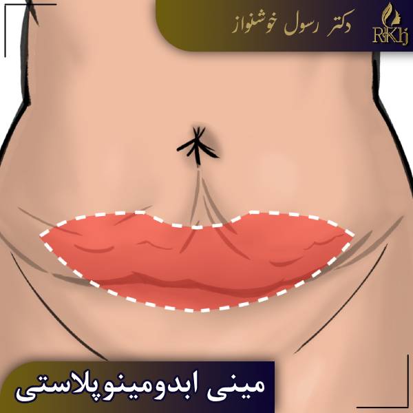 مینی ابدومینوپلاستی