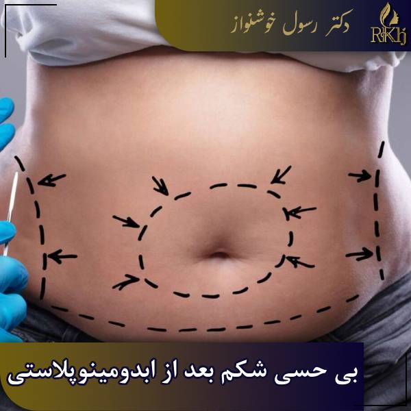 بی حسی شکم بعد از ابدومینوپلاستی