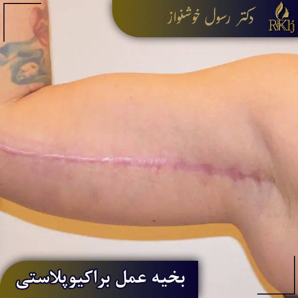بخیه عمل براکیوپلاستی