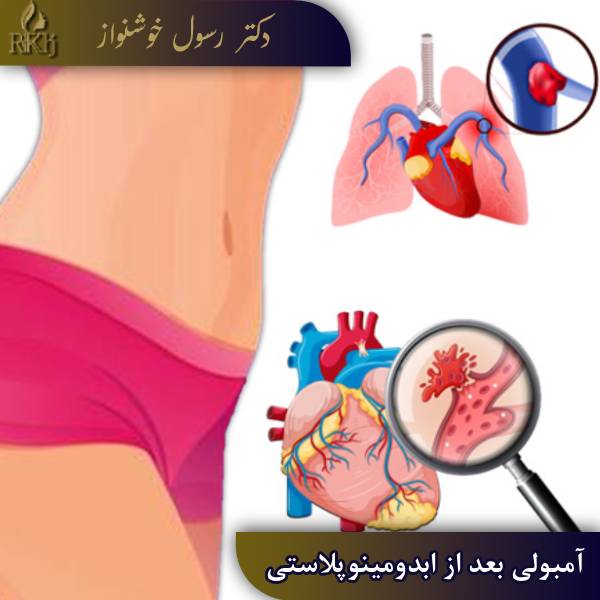 آمبولی بعد از عمل ابدومینوپلاستی