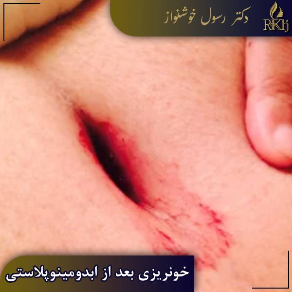 خونریزی بعد از ابدومینوپلاستی