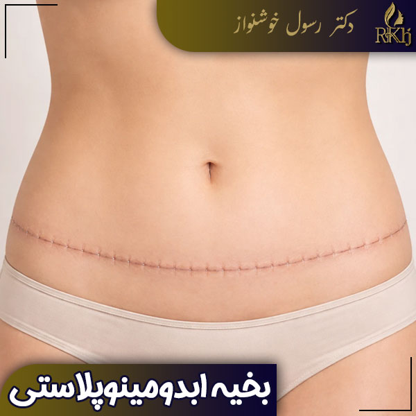 بخیه ابدومینوپلاستی + دکتر رسول خوشنواز